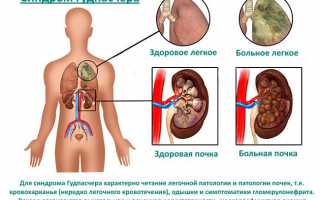 Гудпасчера синдром: проявление симптомов, диагностика и лечение