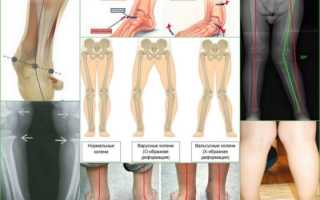 Вальгусная деформация голеней