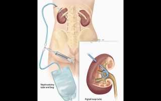 Можно ли рожать с одной почкой: показания и противопоказания