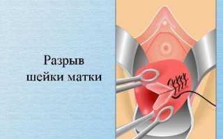 Разрыв шейки матки при беременности: причины, симптомы, риски