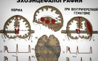 Что такое эхоэнцефалография головного мозга (ЭхоЭГ), что она показывает и какие имеет преимущества