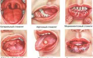 Воспаление слизистой оболочки полости рта: причины и лечение