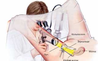 Что такое кольпоскопия — описание метода и его особенности