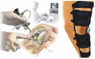 Операция на коленном суставе при повреждении мениска
