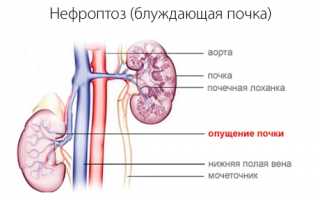 Диетическое питание при нефроптозе: полезные и запрещенные продукты