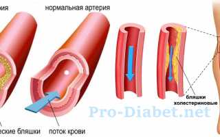 Лечится ли атеросклероз сосудов полностью?