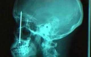 Что показывает рентген носовых пазух и как часто его можно делать