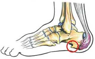 Лечение пяточной шпоры лазером