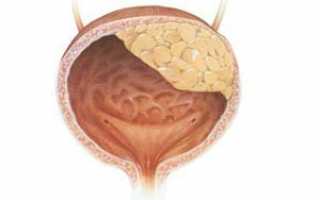 Опухоль мочевого пузыря – симптомы, типы, лечение