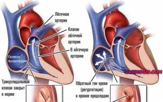 Насколько опасна трикуспидальная регургитация?