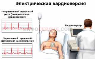 Для чего проводится дефибрилляция сердца?