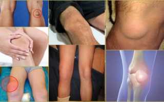 Симптоматика и лечение гигромы коленного сустава