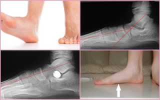 Рентгенодиагностика стопы при плоскостопии