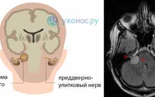 Невринома слухового нерва: причины, признаки, терапия, операция по удалению