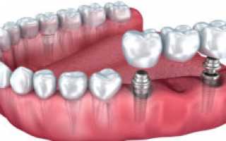 Имплантация зубов – противопоказания и возможные осложнения
