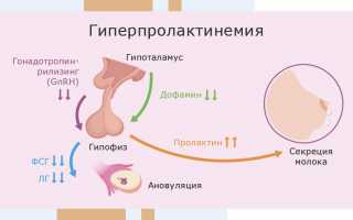 Гиперпролактинемия при беременности: что за патология, ее причины и методы устранения