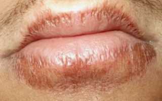 Хейлит на губах: причины, симптомы, методы лечения