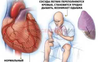 Алгоритм и правила оказания неотложной помощи при острой сердечной недостаточности