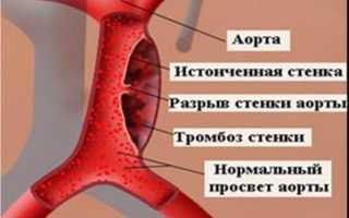 Все о разрыве аорты: причины, симптомы и шансы выжить