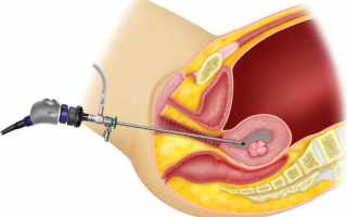 Гистероскопия: что за процедура, ее виды, когда назначается