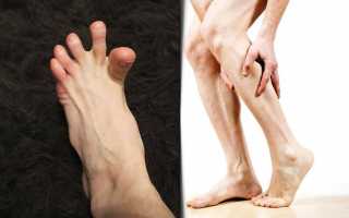 Почему сводит руки и ноги — что делать, чем и как лечить судороги?