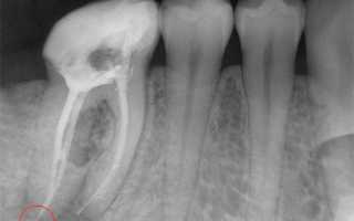 Болит зуб после пломбирования: насколько это опасно, причины и что делать