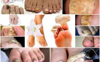 Как определить грибок на ногтях ног