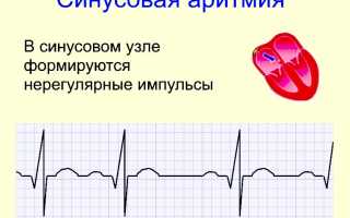 Синусовая аритмия: симптомы и методы лечения