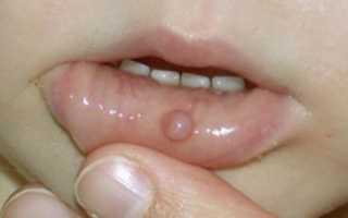 Пузырьки на внутренней стороне губы: причины, симптомы, лечение, фото