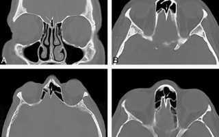 Обследование пазух носа с помощью КТ — особенности диагностики, подготовка и результат