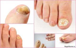 Что такое грибок ногтей на ногах — чем и как лечить поражение ногтевой пластины?
