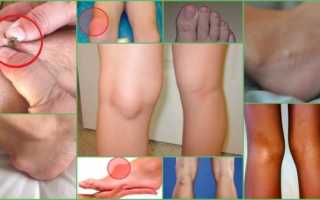 Киста на ноге: виды, симптоматика, методы лечения