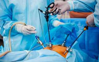 Лапароскопия при желчнокаменной болезни — подготовка, ход процедуры и реабилитация