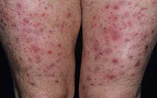 Дерматит на ногах — фото с описанием симптомов, лечение, причины