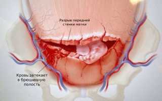 Разрывы матки при беременности — как определить и что делать