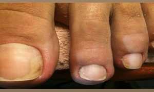 Чем опасен грибок ногтей (осложнения, последствия)