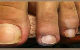 Чем опасен грибок ногтей (осложнения, последствия)