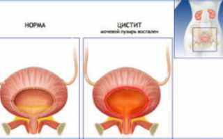 Что такое цистит – типы, причины, признаки, лечение