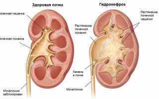 Причины и степени гидронефроз у детей: лечение и профилактика