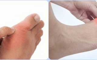Болит сустав большого пальца на ноге — что делать, чем и как лечить?