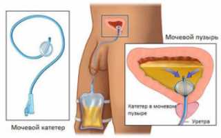 Катетеризация мочевого пузыря — показания, алгоритм проведения