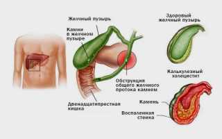 Как делают УЗИ желчного пузыря: показания, подготовка, методы проведения, заключение, цены