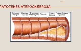 Этиология и патогенез атеросклероза — стадии развития заболевания сосудов