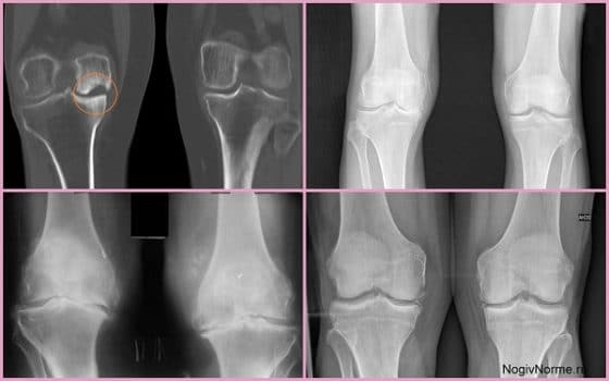 1 и 2 степень развития артроза колена