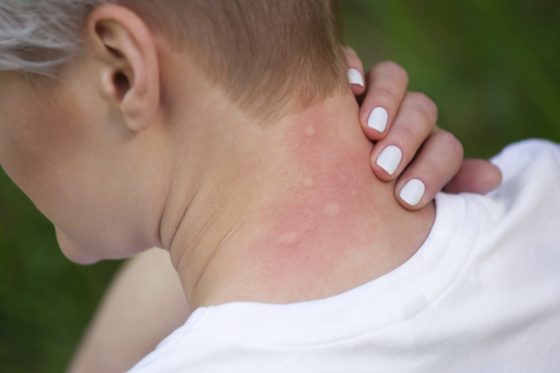 В качестве побочного эффекта от применения Драстопа возможно появление аллергических высыпаний