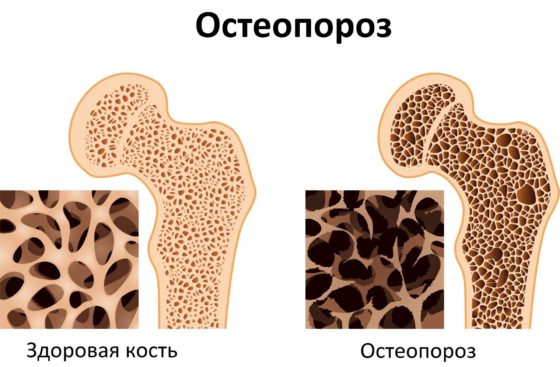 Остеопороз - одно из показаний к применению Дьюралана