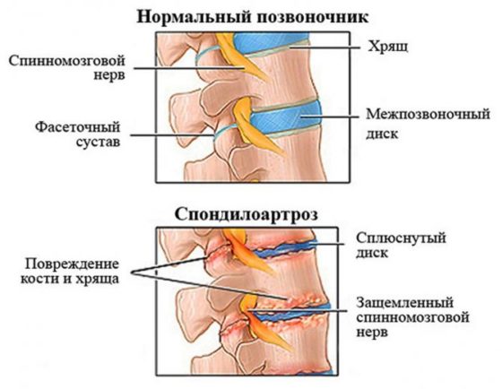 Спондилоартроз - одно из показаний к применению препарата Артрон Триактив