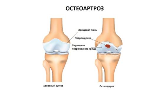 Остеоартроз - одно из показаний к применению Артелара