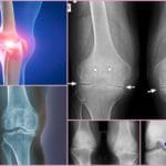 2 и 3 степень артроза колена