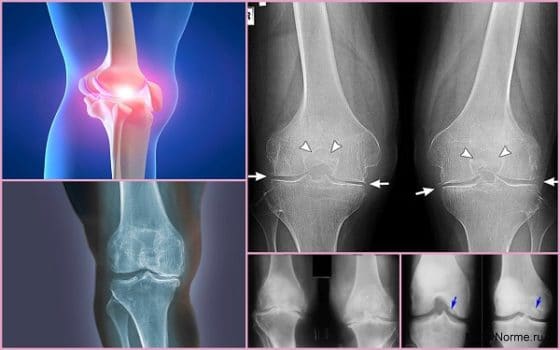 2 и 3 степень артроза колена